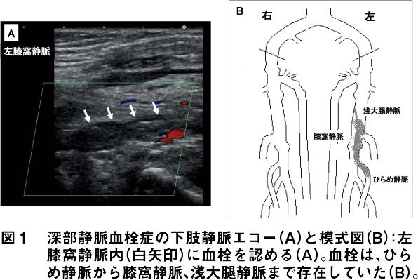 図1 深部静脈血栓症の下肢静脈エコー（A）と模式図（B）