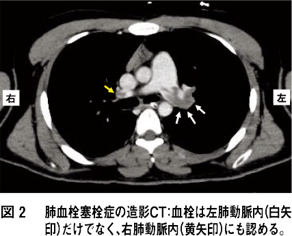 図2 肺血栓塞栓症の造影CT